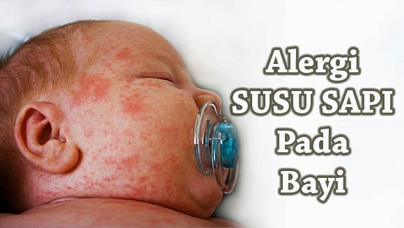 Penting Inilah 7 Gejala Alergi Susu Sapi Pada Anak Bayi 